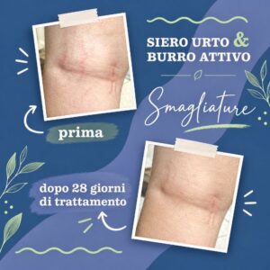 Trattamento smagliature - La Saponaria